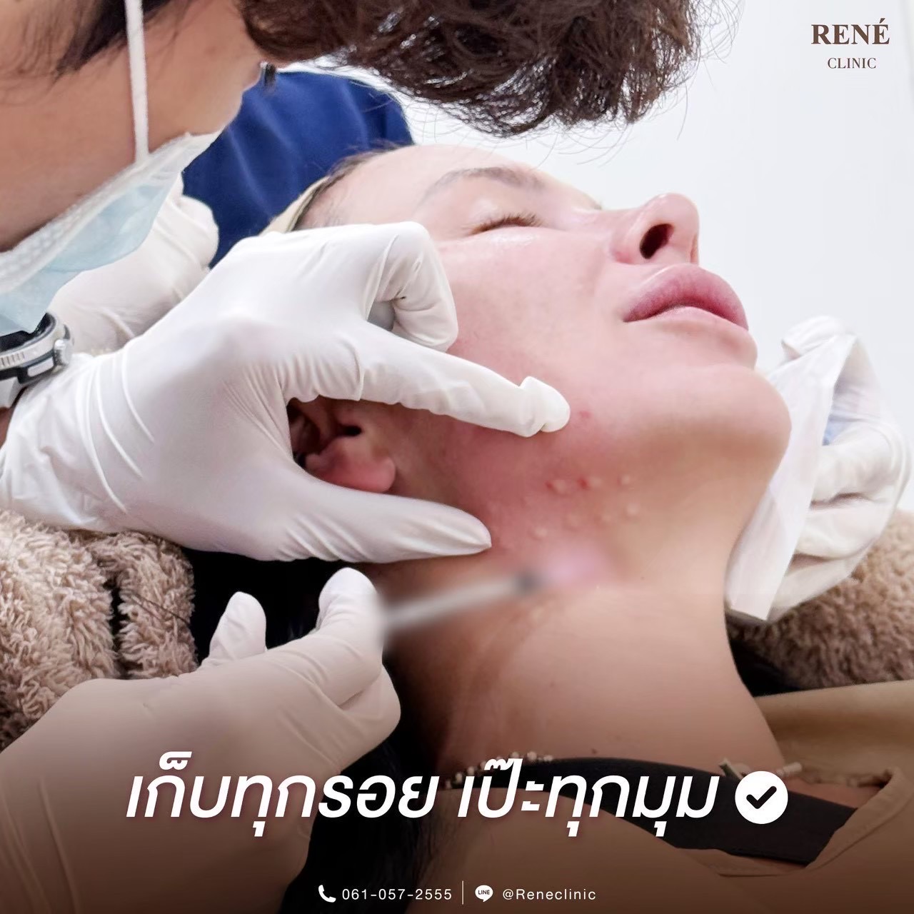 รีวิว Botox #1