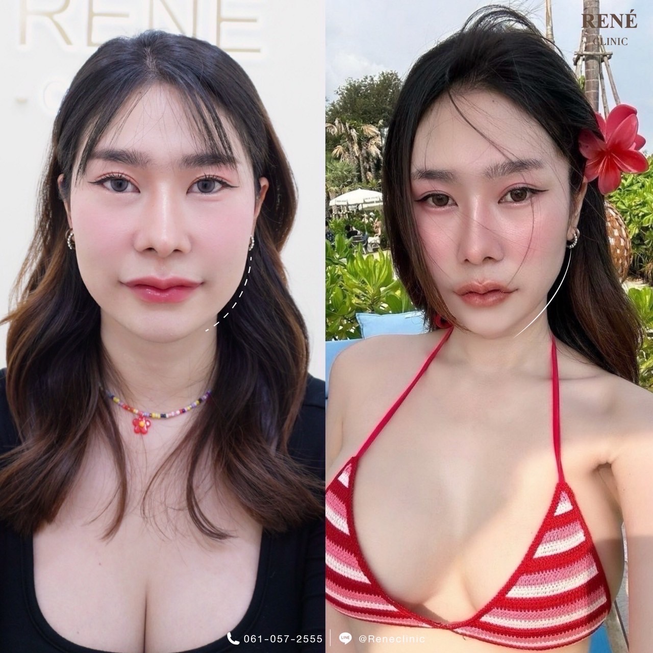 รีวิว Botox #10