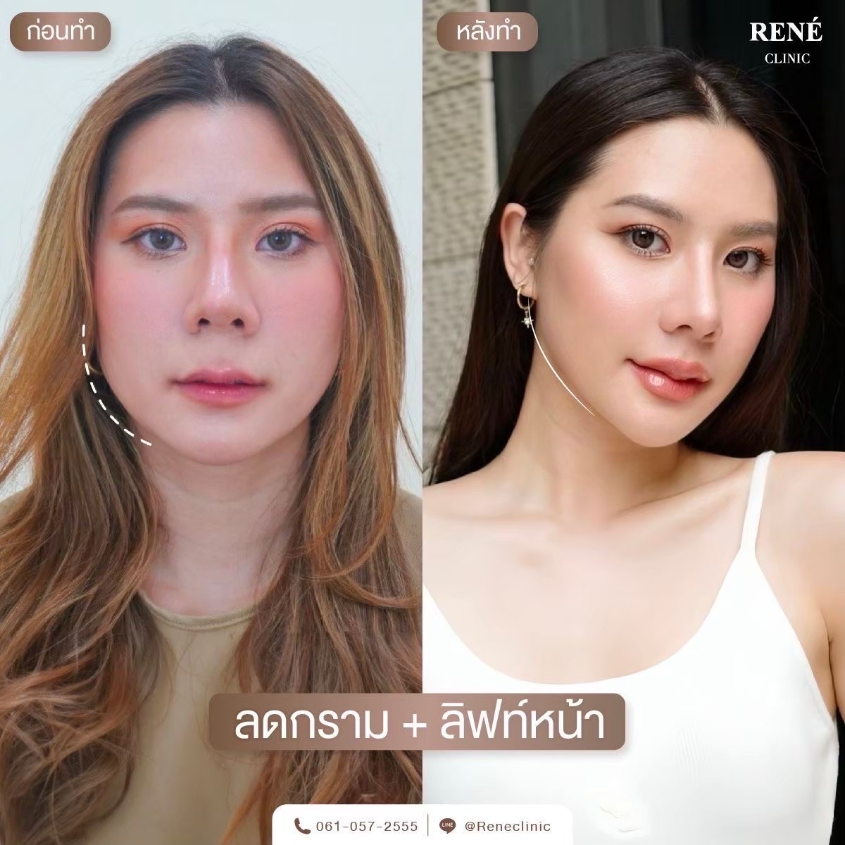 รีวิว Botox #4