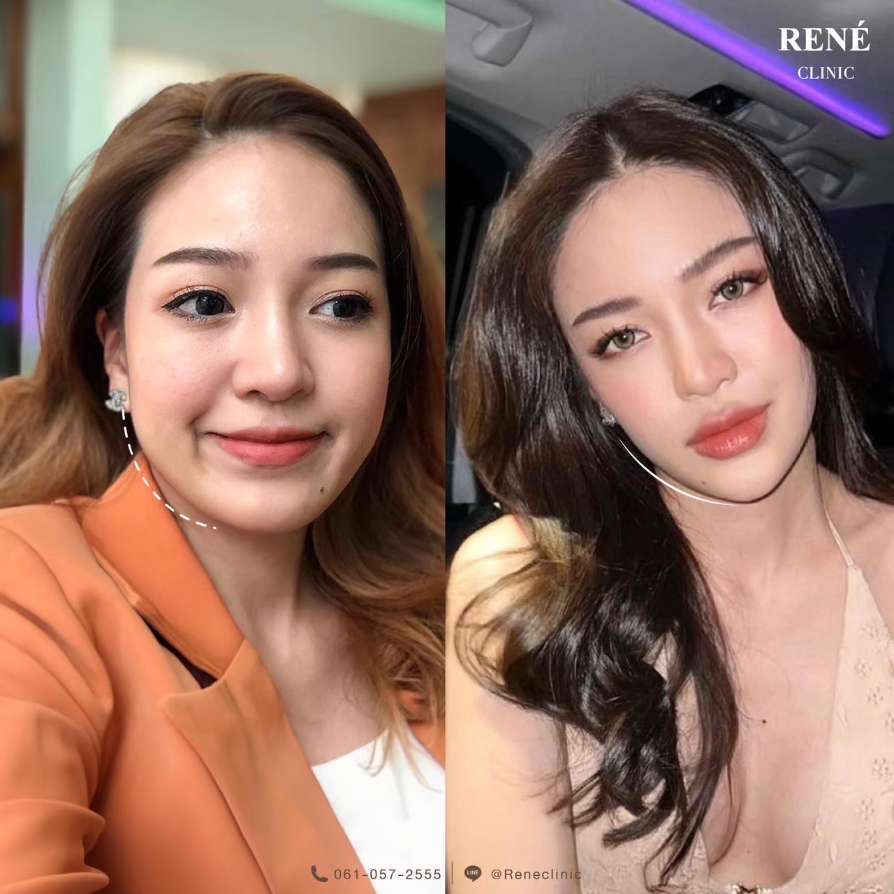 รีวิว Botox #5
