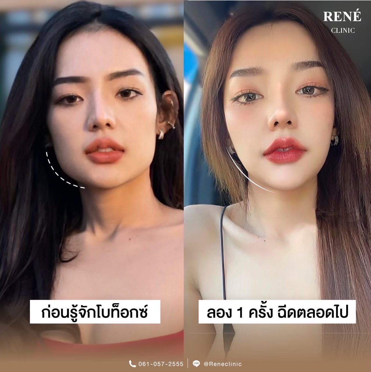 รีวิว Botox #6