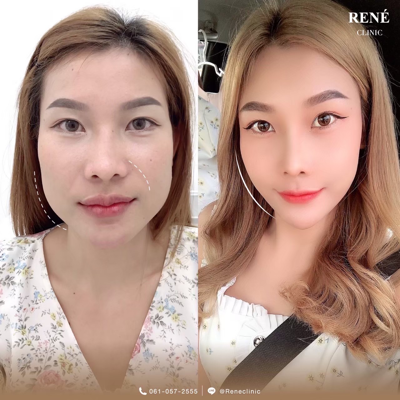 รีวิว Botox #7