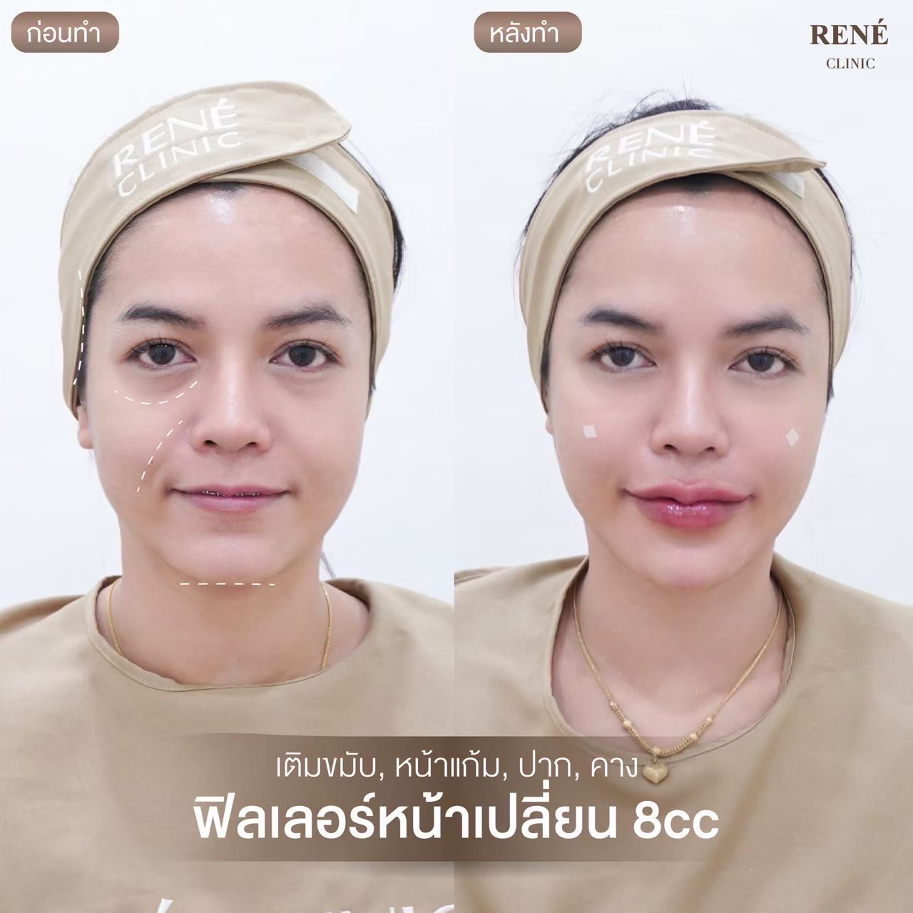 รีวิว Filler #24