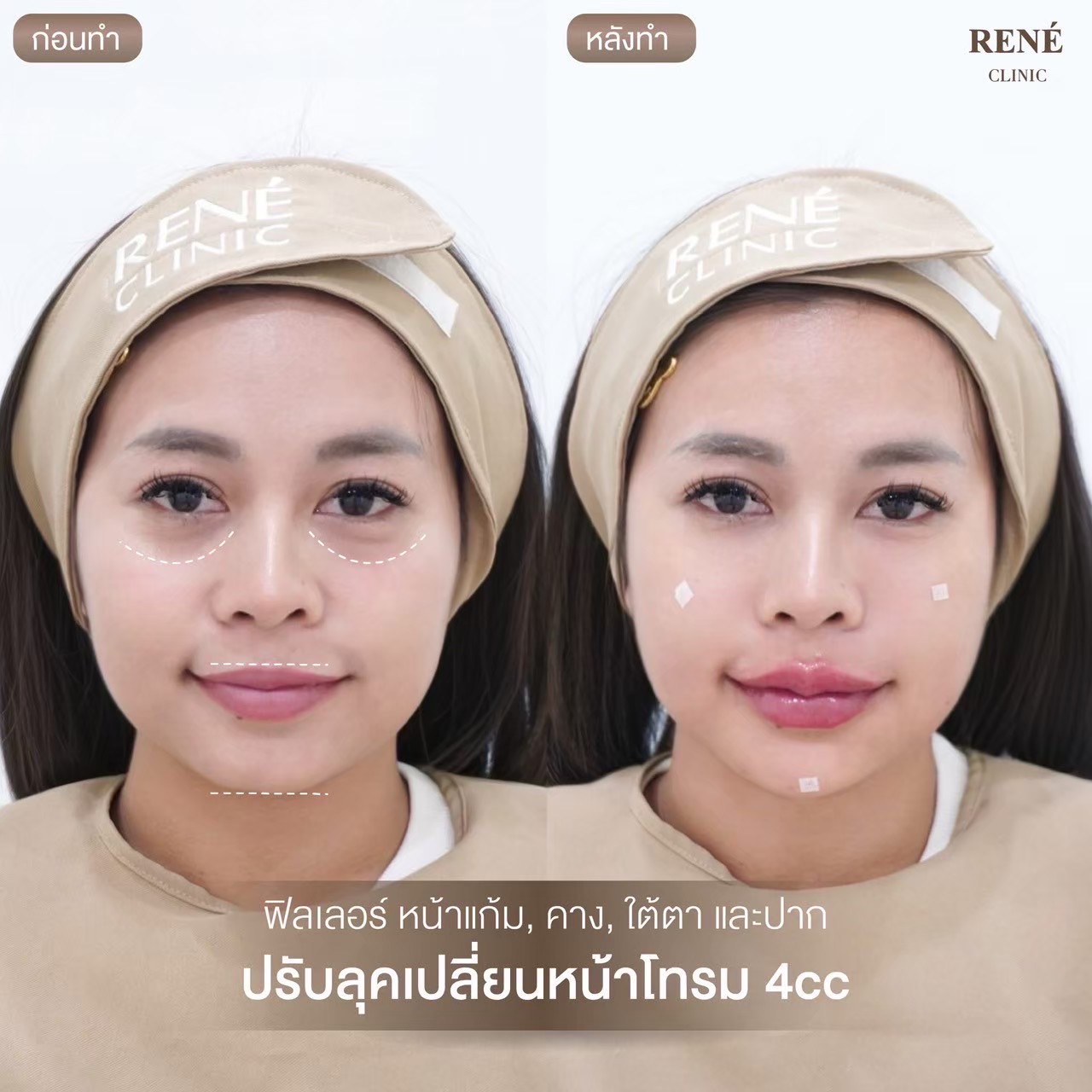 รีวิว Filler #25