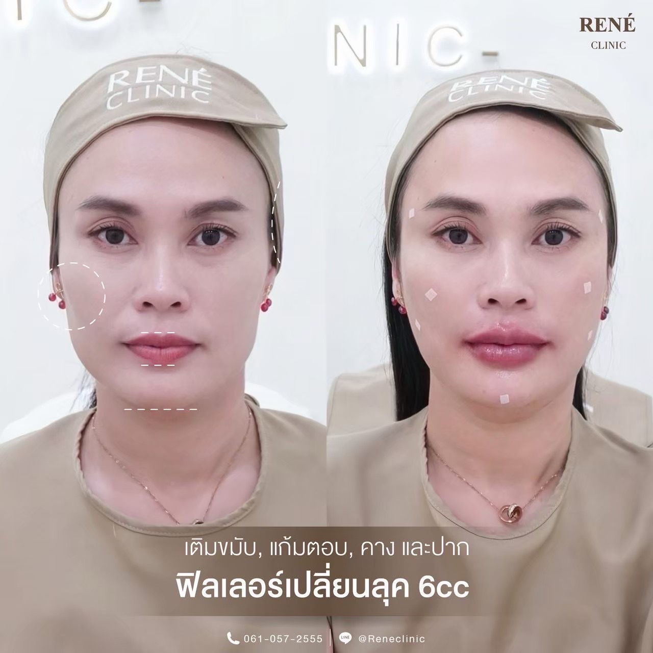 รีวิว Filler #26