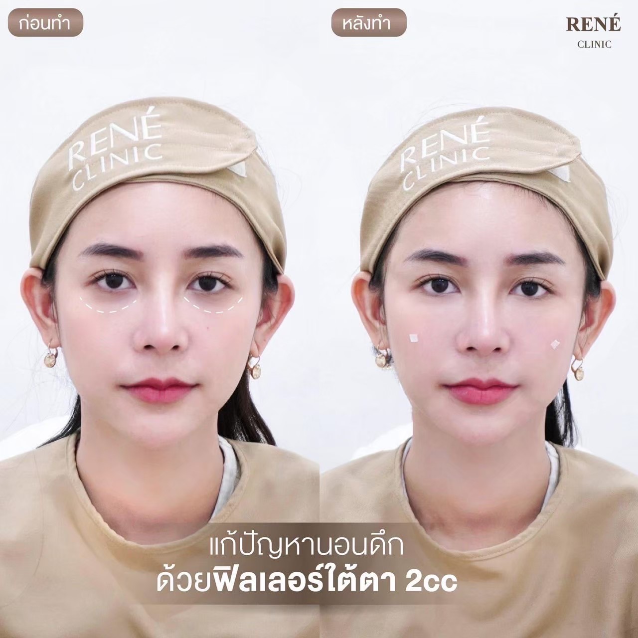 รีวิว Filler #27