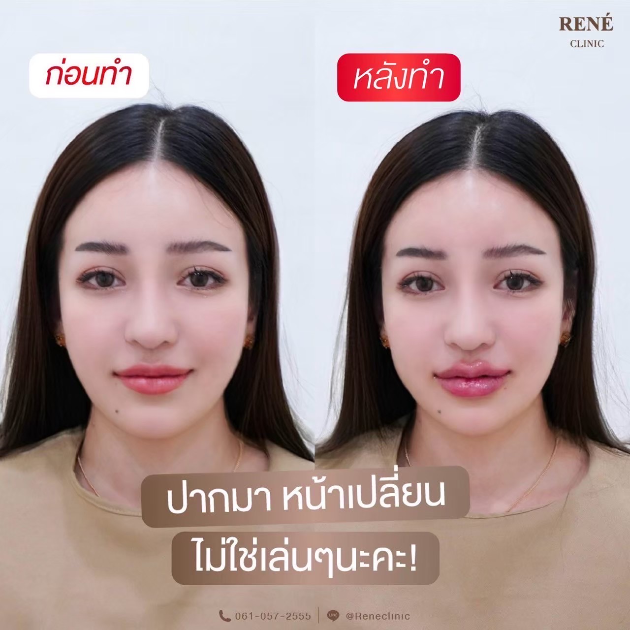 รีวิว Filler #28