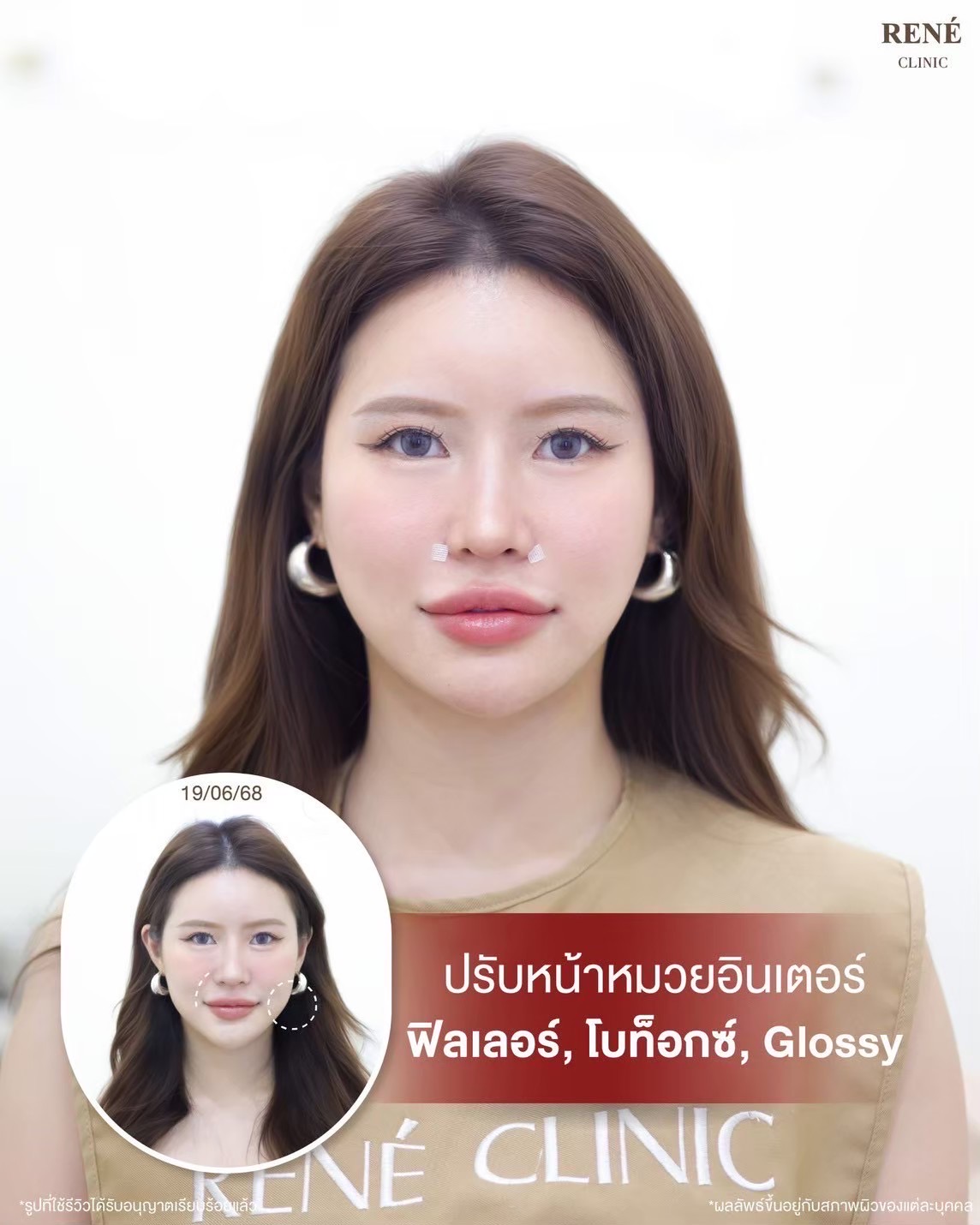 รีวิว Filler #29