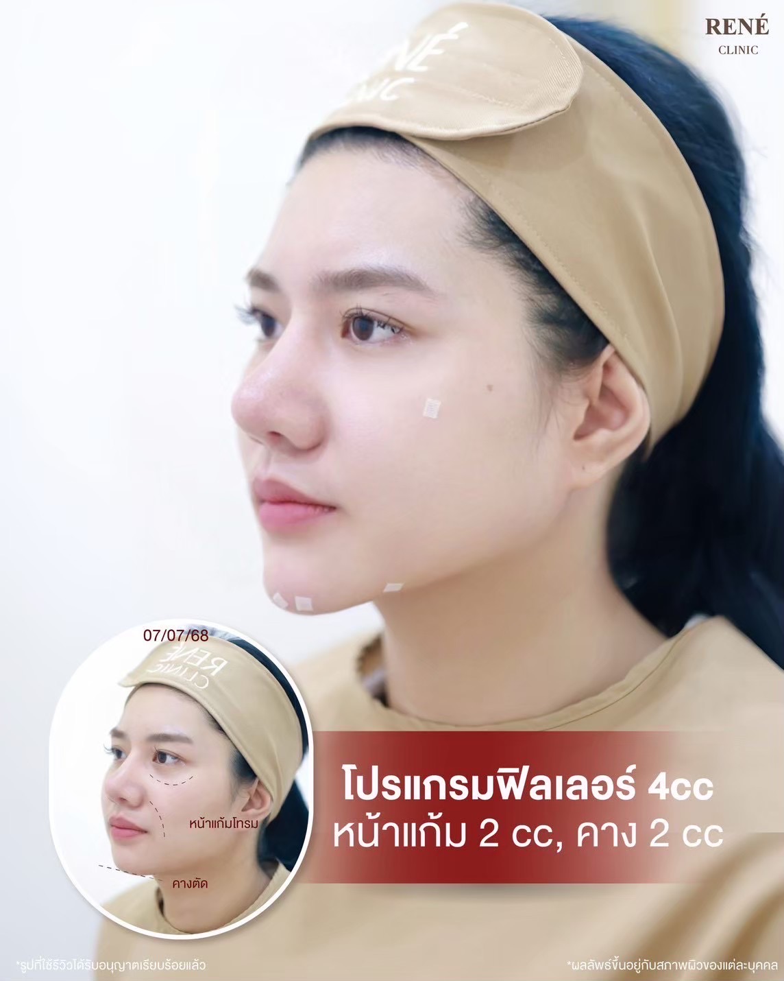 รีวิว Filler #30