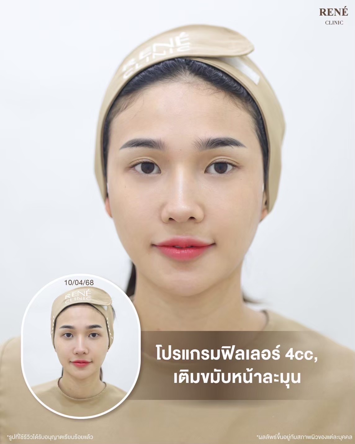 รีวิว Filler #31