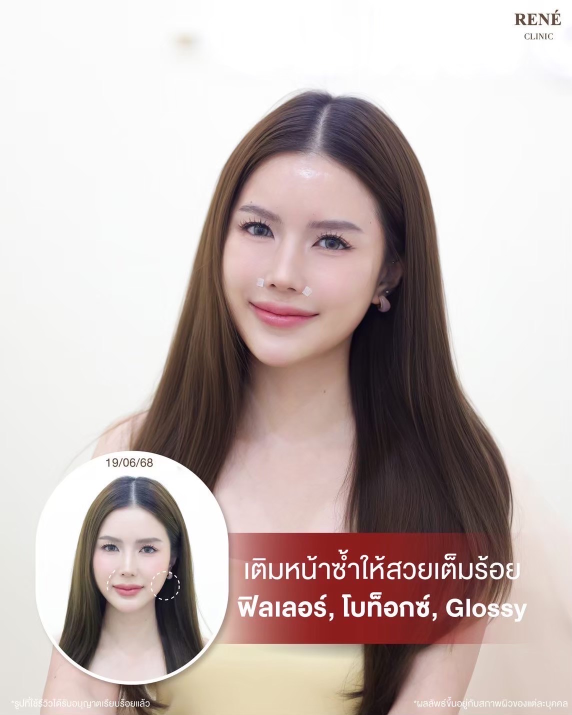 รีวิว Filler #32