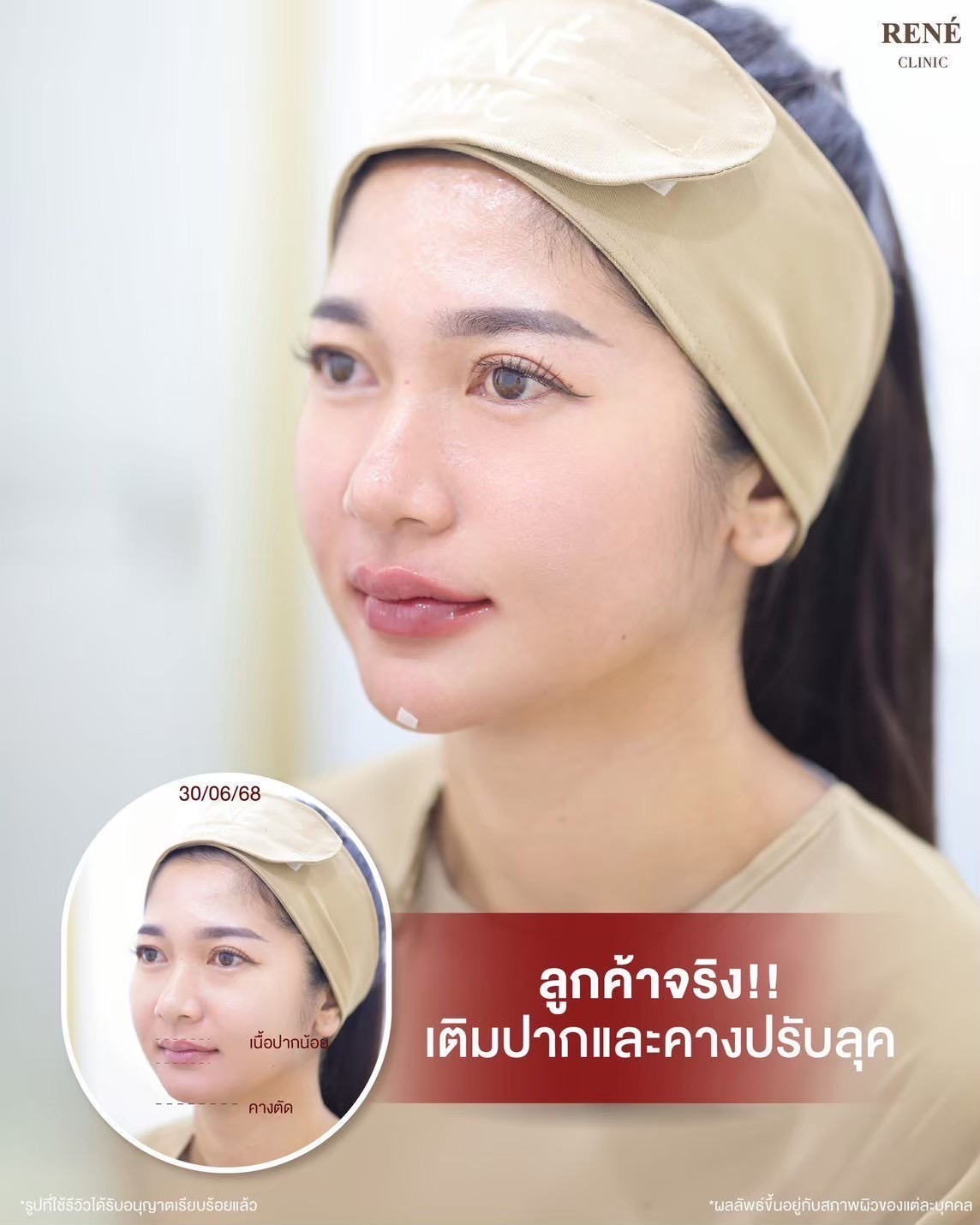 รีวิว Filler #33