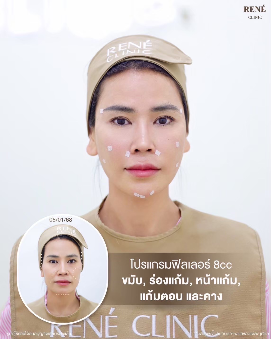 รีวิว Filler #34