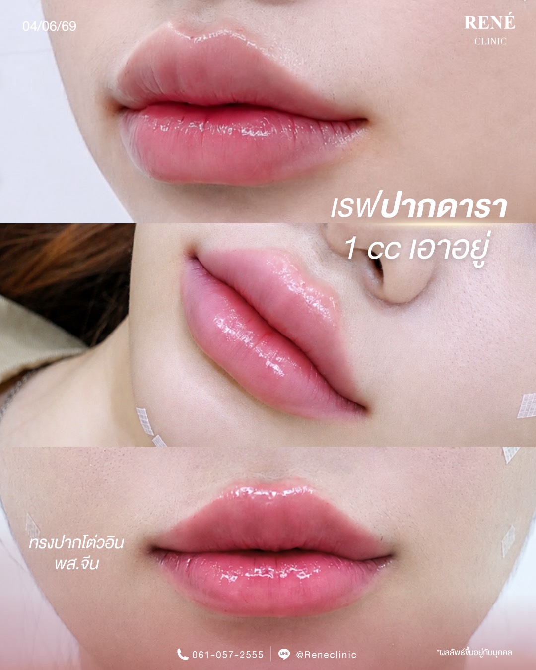 รีวิว Filler #35